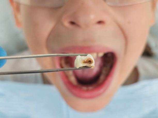 Best Emergency Root Canal Treatment in Bertville, AL